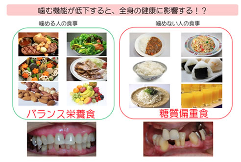 噛む機能が低下すると、全身の健康に影響する