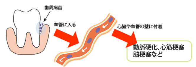 歯周病菌が動脈硬化や心筋梗塞、脳梗塞などを引き起こす