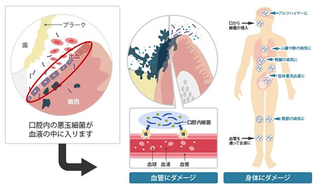 口腔内の悪玉細菌が血液の中に入り、血管や身体にダメージを与える