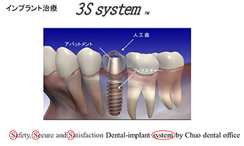 インプラント治療 3S system