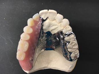 金属床デンチャー