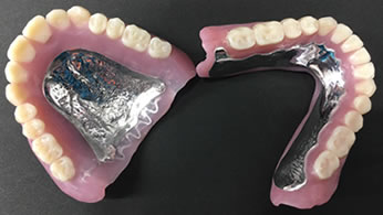 シリコンデンチャー