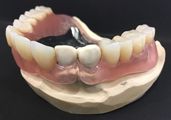 金属床+エステデンチャー(ノンクラスプ)