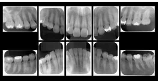 X-Ray(レントゲン)写真