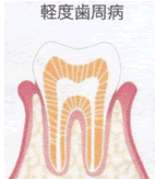 軽度歯周病
