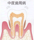 中度歯周病