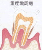 重度歯周病