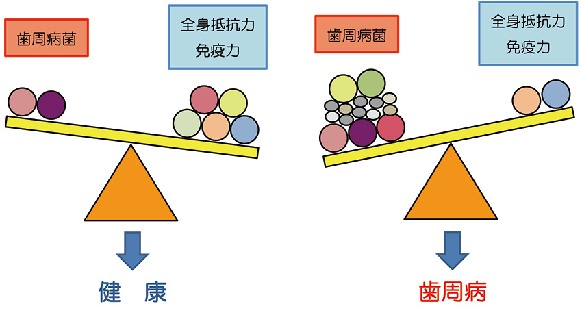 歯周病の成り立ち